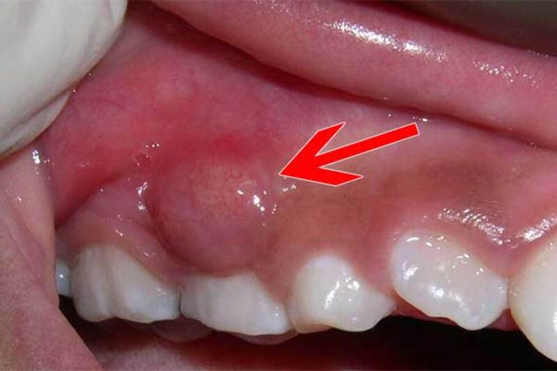 Đây còn được gọi là bệnh nhiễm trùng thường do sâu răng và các bệnh lý về răng miệng gây ra