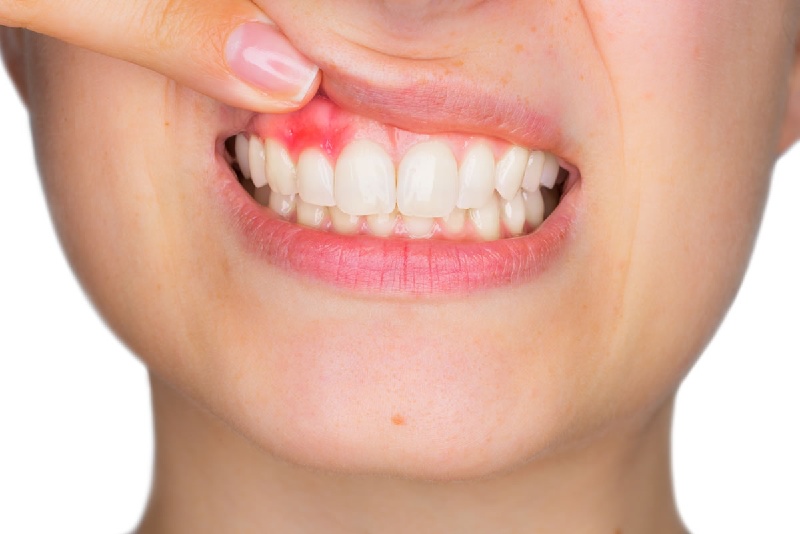 Viêm nha chu là tình trạng bệnh lý gây ra viêm nhiễm trên diện rộng của các mô xung quan răng