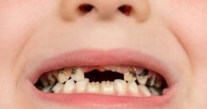 Bé bị sún răng phải làm sao, nguyên nhân và cách điều trị hiệu quả