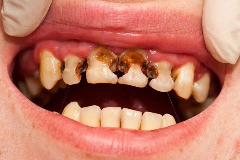 Trẻ bị sún răng gây ảnh hưởng tới thẩm mỹ và sức khỏe, răng bị đen xỉn, đau buốt khi nhai
