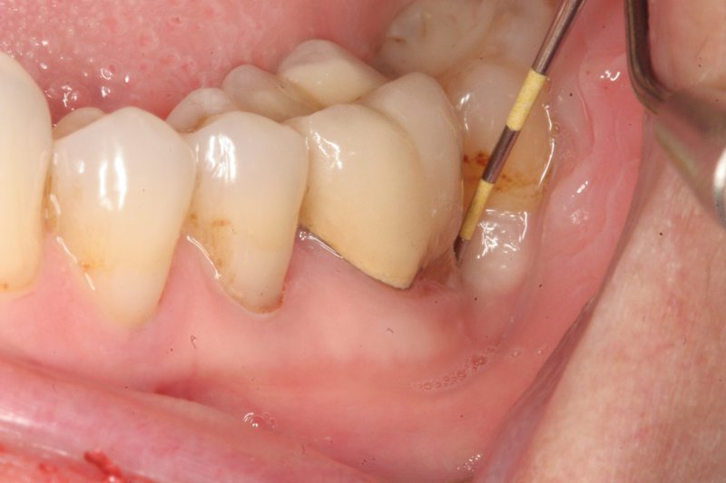 Viêm chân răng gây ra tình trạng nướu bị sưng tấy và viêm nhiễm