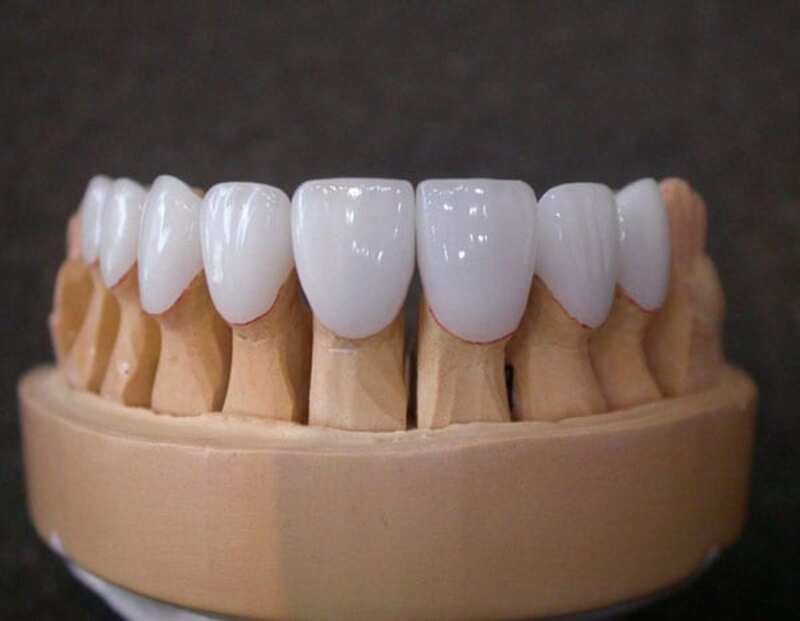Răng sứ Titan sẽ rất phù hợp cho răng không cần thẩm mỹ cao