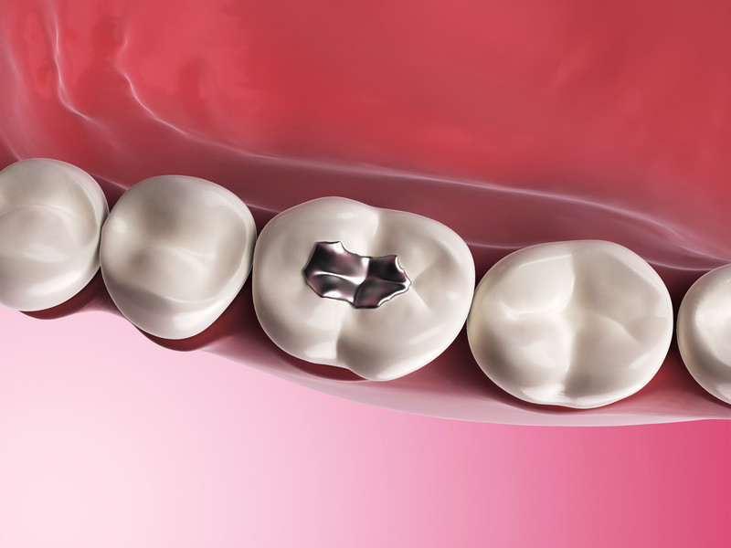 Miếng trám răng quá lớn khiến cho cấu trúc răng còn lại yếu
