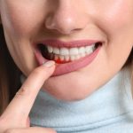 12 cách chữa viêm nha chu tại nhà bằng thảo dược hiệu quả