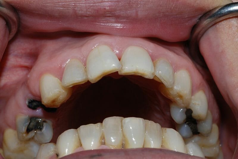Ảnh sâu răng do vi khuẩn tấn công răng