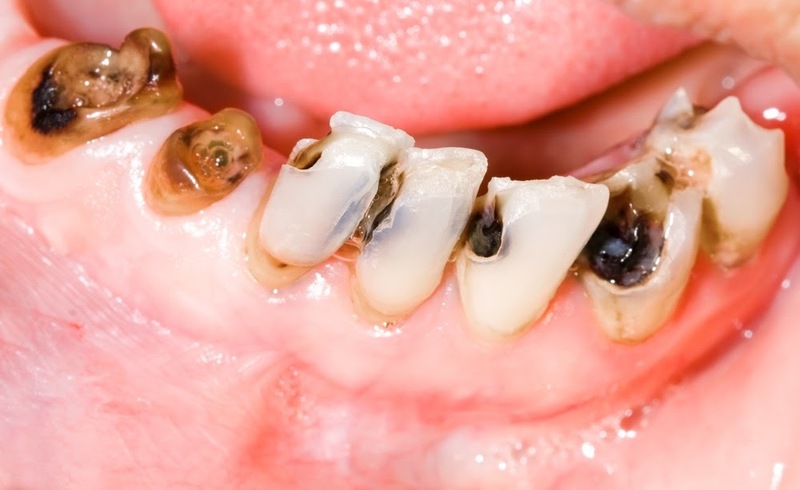 Sâu răng cũng có thể gây ra tình trạng áp xe
