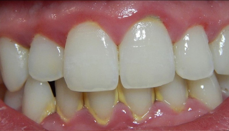Những hình ảnh sâu răng do mảng bám và axit trong mảng bám gây ra