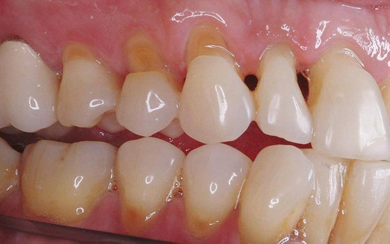 Men răng bị mòn gây tổn thương cho răng vĩnh viễn khiến răng bị ngả màu
