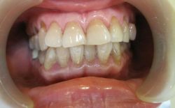 Mòn men răng là gì, nguyên nhân và cách điều trị hiệu quả