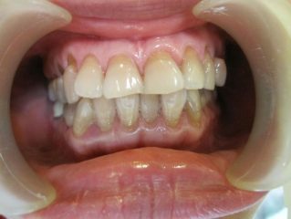 Mòn men răng là gì, nguyên nhân và cách điều trị hiệu quả