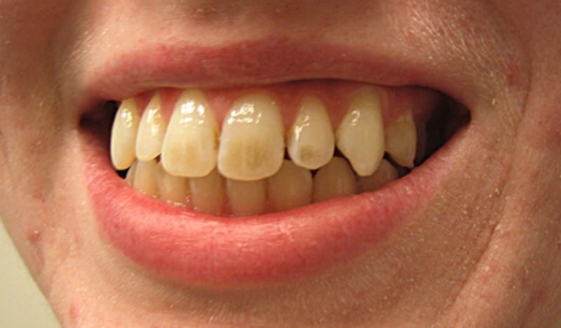Men mòn khiến răng yếu hơn, có nhiều vết nứt và ngả màu vàng