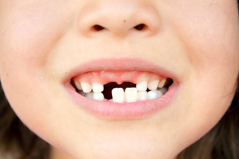 Nếu nhổ răng sữa cho bé quá sớm có thể gặp phải một số bệnh lý về răng miệng
