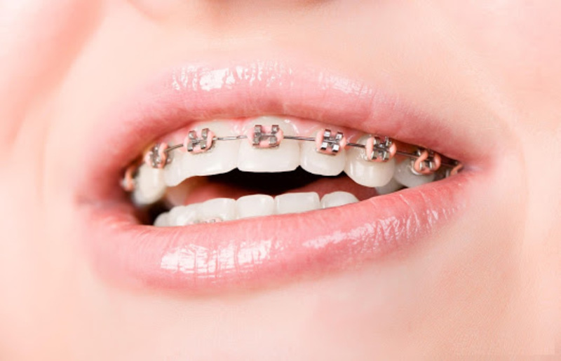 Tùy vào tình trạng răng miệng mà có mức chi phí chỉnh nha khác nhau