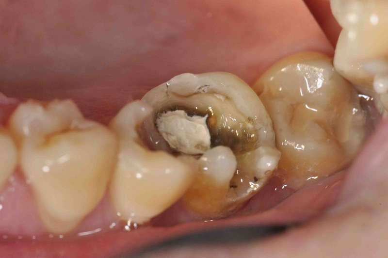 Đây là bệnh lý răng miệng phổ biến nhất không chỉ ở trẻ em mà còn ở người lớn
