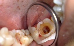 Sâu răng: Nguyên nhân, dấu hiệu và cách điều trị