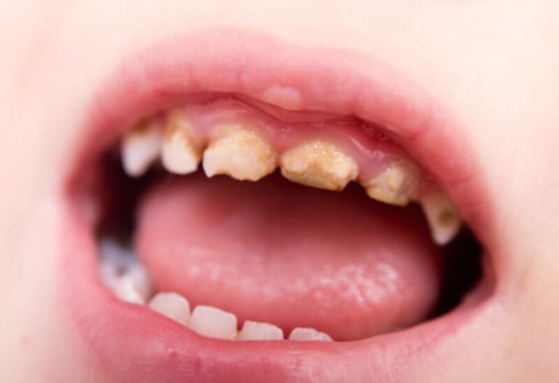 Tình trạng trẻ bị sún răng thường xuất hiện khi bé 1 - 3 tuổi