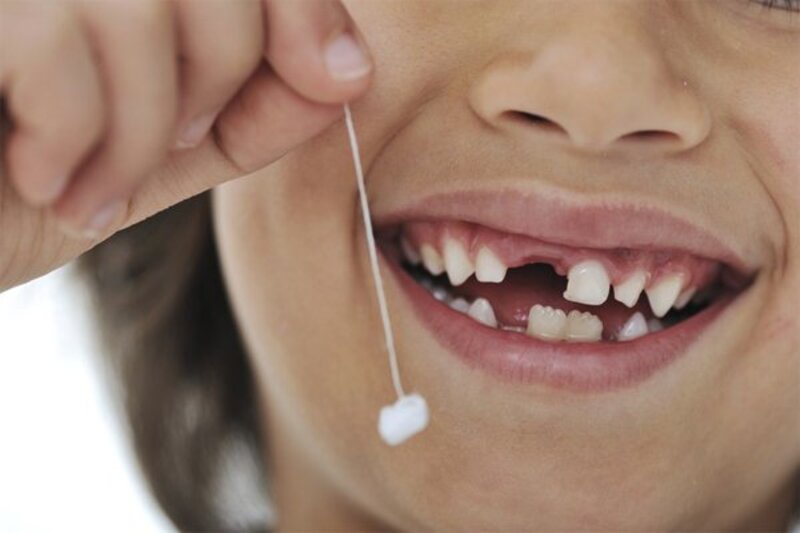 Cần điều trị kịp thời có thể dẫn đến hỏng răng và cần phải nhổ bỏ