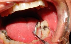 Phương pháp trị sâu răng hiệu quả, an toàn hiện nay