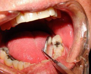 Phương pháp trị sâu răng hiệu quả, an toàn hiện nay