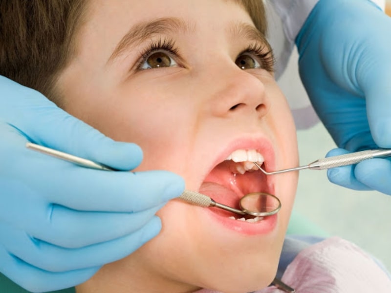 Sâu răng là bệnh lý rất phổ biến ở trẻ gây ảnh hưởng đến tinh thần lẫn thể chất