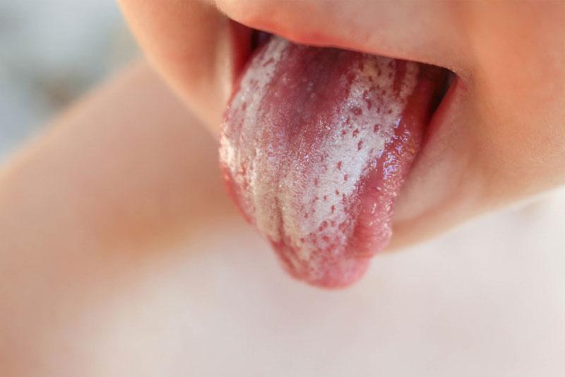 Tưa trắng hình thành do không vệ sinh cho bé sau khi ăn, vi khuẩn tích tụ gây bệnh