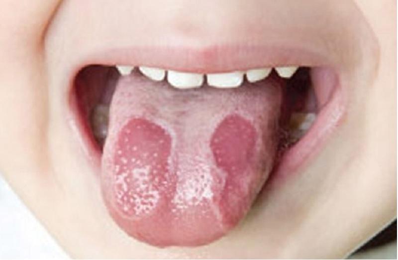 Tưa lưỡi mọc thành từng đám trắng trên lưỡi hoặc quanh khoang miệng của trẻ nhỏ