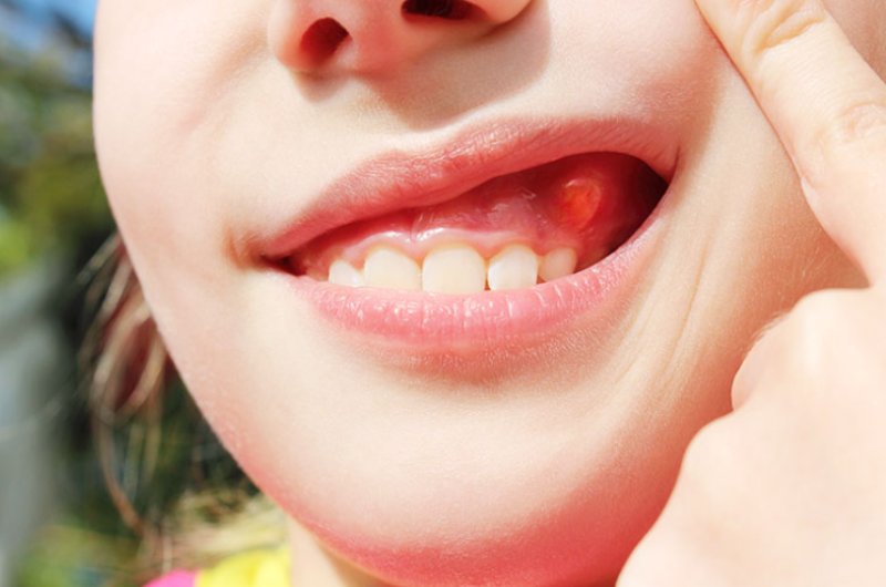 Viêm chân răng có mủ là tình trạng vùng xung quanh chân răng bị lên mủ