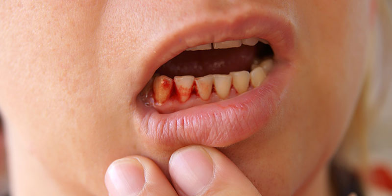 Nguyên nhân bị viêm chóp chân răng là do thiếu vitamin C
