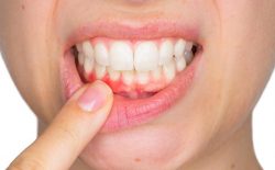 Viêm cận răng là một biểu hiện nặng của bệnh viêm lợi