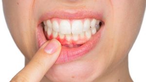 Viêm cận răng là một biểu hiện nặng của bệnh viêm lợi