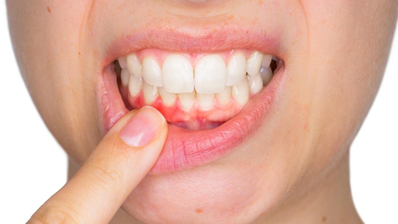 Viêm cận răng là một biểu hiện nặng của bệnh viêm lợi