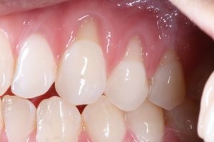 Viêm nha chu cấp: Nguyên nhân và hướng điều trị hiệu quả