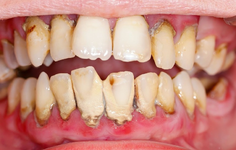 Viêm nha chu cấp tính là tình trạng các tổ chức xung quanh răng đã bị viêm nhiễm ở mức độ nặng