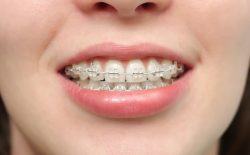 Viêm nha chu khi niềng răng do đâu? Cách khắc phục hiệu quả