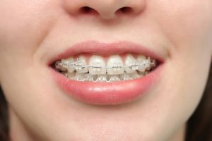 Viêm nha chu khi niềng răng do đâu? Cách khắc phục hiệu quả