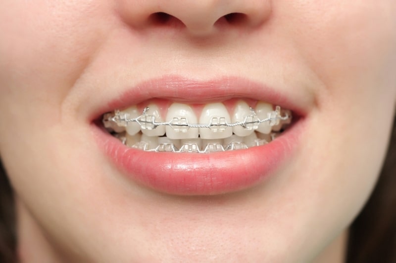 Để đảm bảo bạn nên chọn cơ sở nha khoa uy tín, bác sĩ tay nghề cao để thực hiện niềng răng