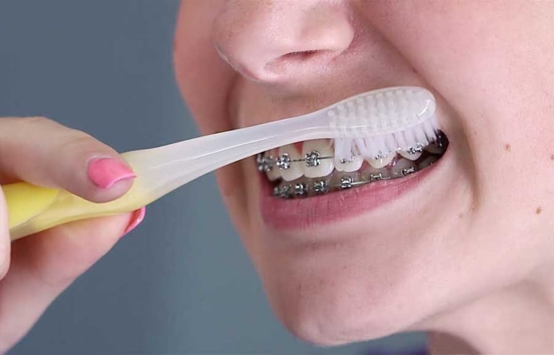 Cần đặc biệt chú ý chăm sóc vệ sinh răng miệng trong quá trình chỉnh nha