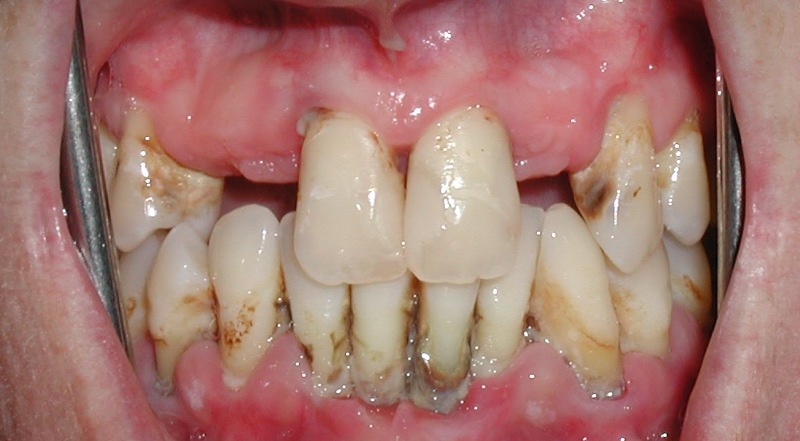 Viêm nha chu mãn tính là tình trạng các các tổ chức quanh răng bị viêm nhiễm nặng, ảnh hưởng đến cấu trúc nâng đỡ của răng