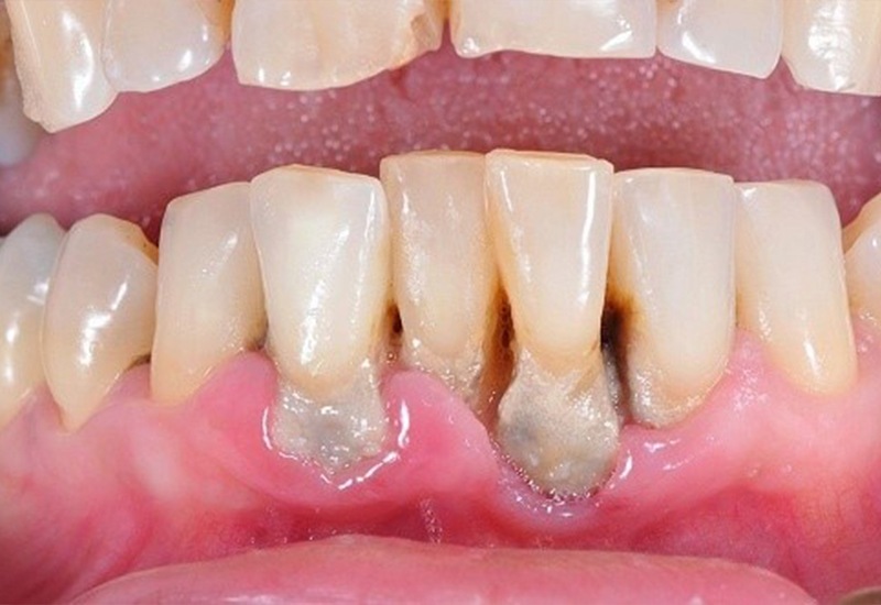Viêm nha chu dẫn đến tình trạng tiêu xương - rụng răng