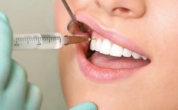 Viêm tủy răng uống thuốc gì để giảm đau và điều trị triệt để