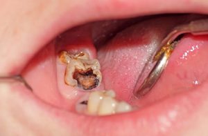 Viêm Tủy Răng: Nguyên Nhân, Triệu Chứng Và Cách Điều Trị