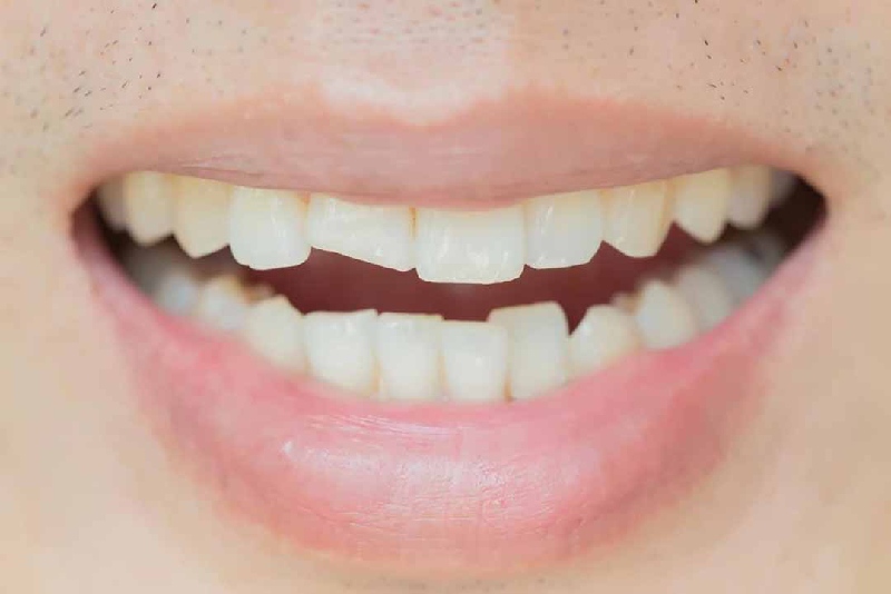 Răng bị sứt mẻ cũng có thể gây ra viêm tủy răng