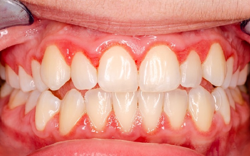 Bệnh viêm nướu có thể gây ra viêm tủy răng