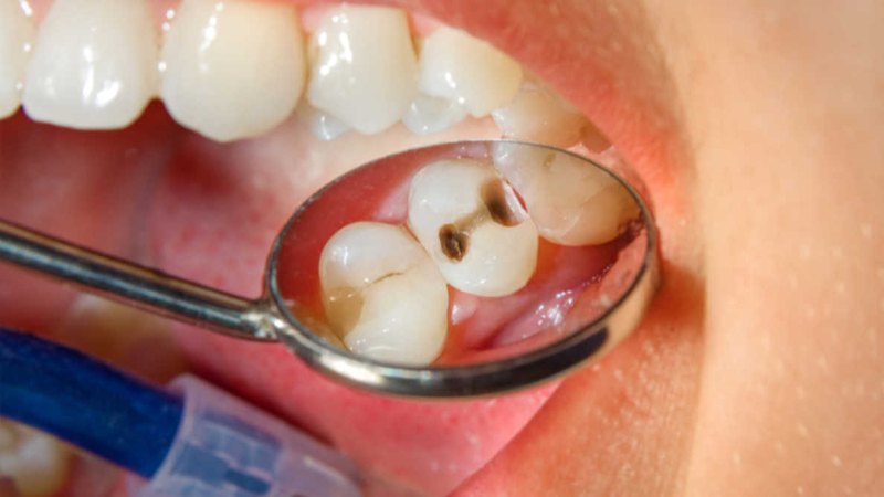 Viêm tủy răng ở bà bầu có thể do vi khuẩn xâm nhập theo lỗ sâu răng