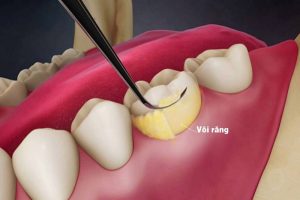 Cách chữa viêm nha chu cho bà bầu dứt điểm, ngăn tái phát