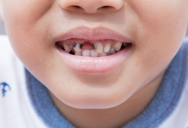 Áp xe răng ở trẻ em nguy hiểm hơn so với với người trưởng thành