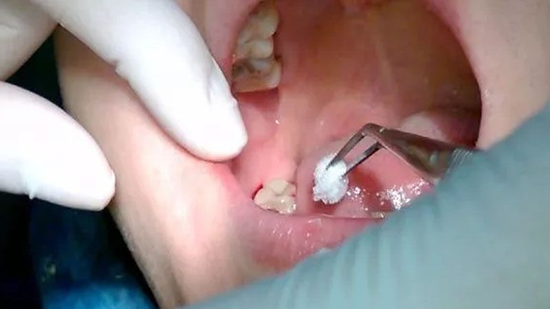Biểu hiện áp xe răng