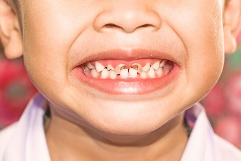 Việc điều trị các bệnh lý về răng miệng không dứt điểm cũng có thể dẫn đến viêm tuỷ răng
