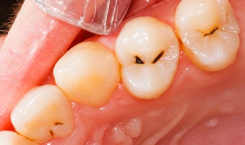 Viêm tủy răng có hồi phục là tình trạng tủy răng bị viêm nhiễm ở cấp độ nhẹ