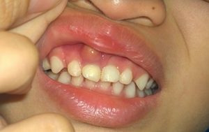 Viêm tủy răng có mủ là bệnh gì, giải pháp chữa trị an toàn